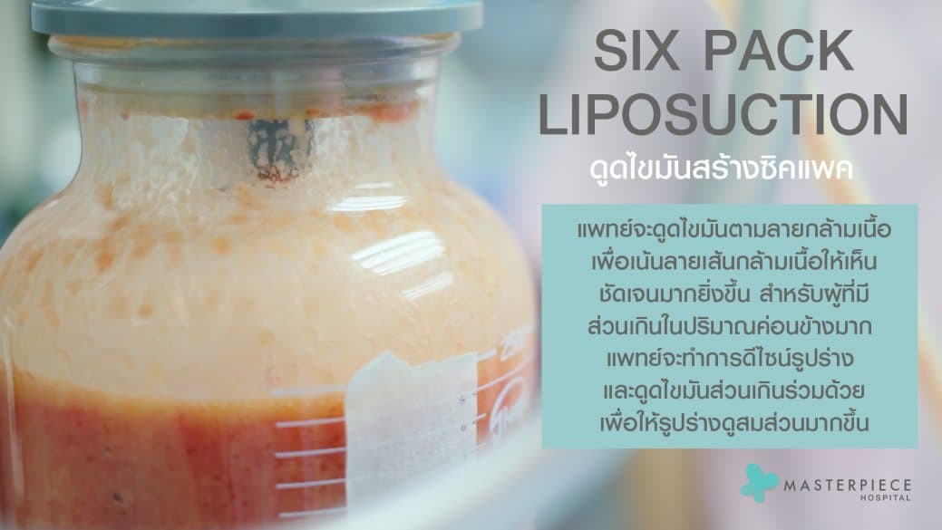 ดูดไขมัน ซิกแพค (SIX PACK LIPOSUCTION)