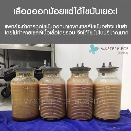 ถังไขมัน ดูดไขมัน ตัว VASER LIPOSUCTION