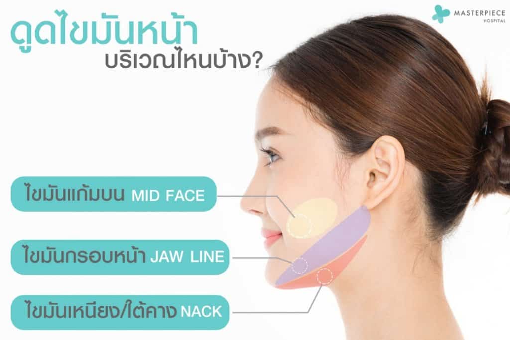 จุดที่ดูดไขมันหน้า Facial Vaser Liposuction
