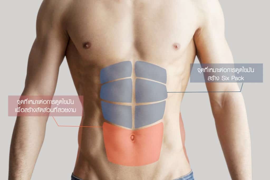 บริเวณที่จะดูดไขมัน (SIX PACK LIPOSUCTION)