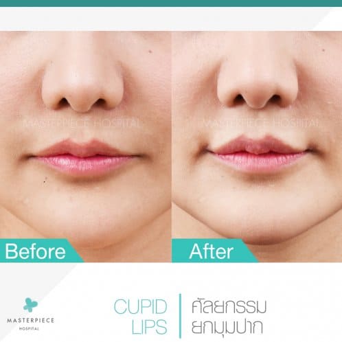 B&A ศัลยกรรม ยกมุมปาก