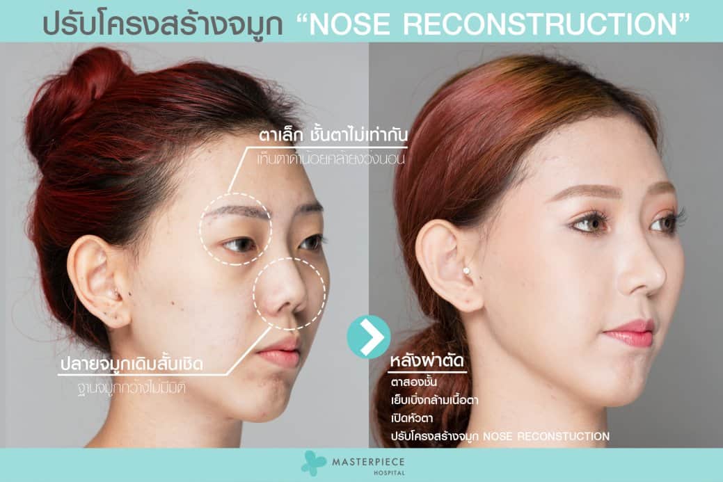 ปรับโครงสร้างจมูก