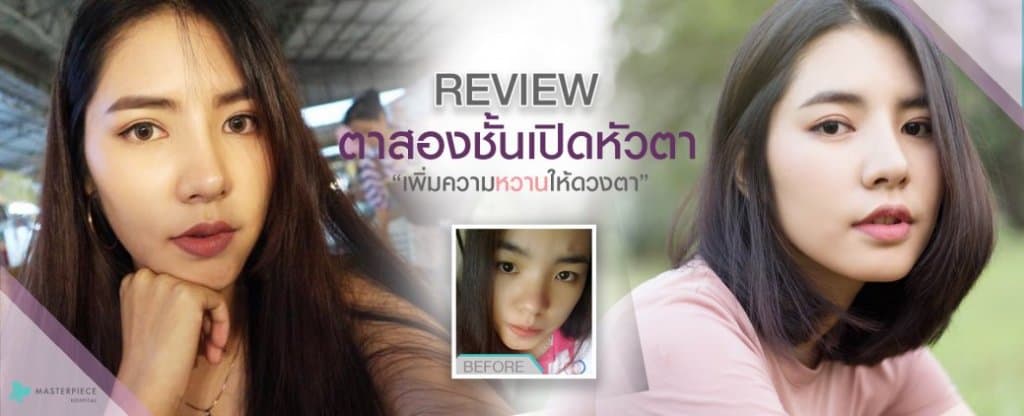 รีวิว ศัลยกรรมผ่าตัดเปิดหัวตา