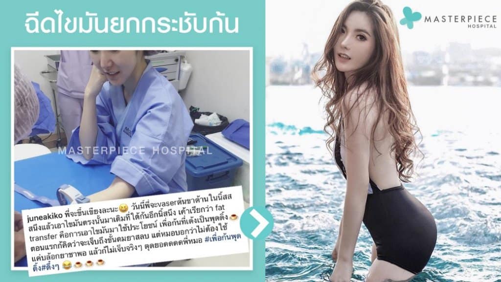 รีวิว ฉีดไขมันยกกระชับก้น