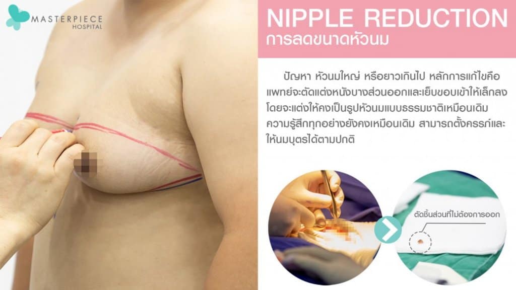 การผ่าตัดลดขนาดหัวนม