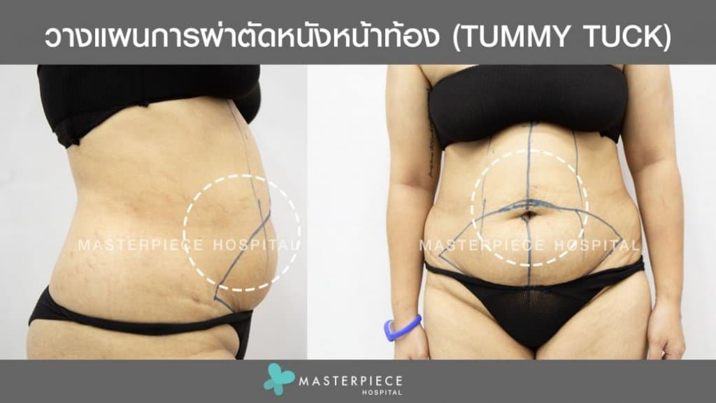 จุดผ่าตัด ตัดหนังหน้าท้อง tummy