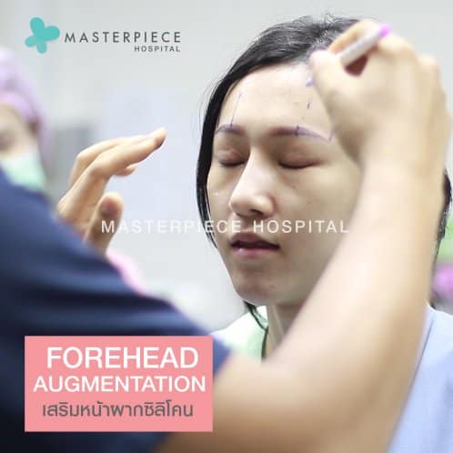 เสริมหน้าผากซิลิโคน
