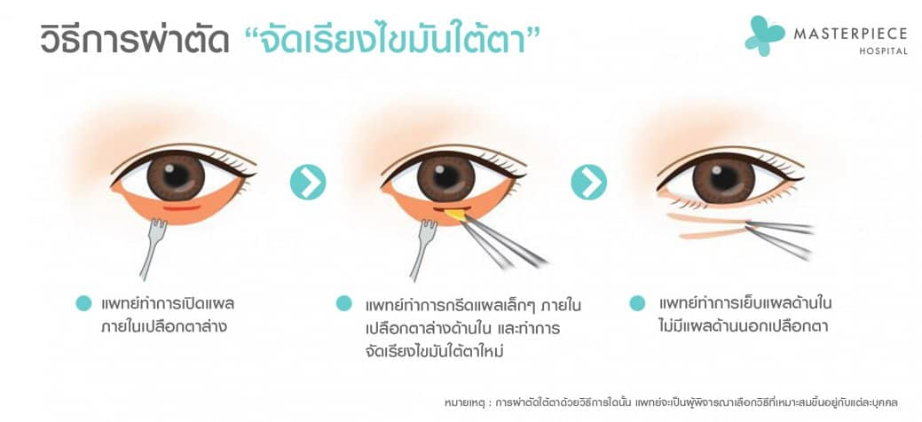 วิธีจัดเรียงไขมันใต้ตา