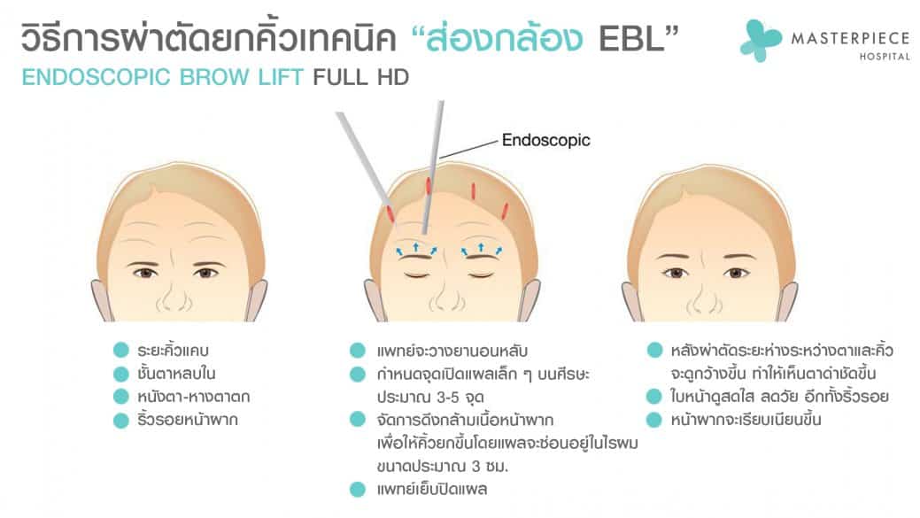 วิธีผ่าตัด EBL