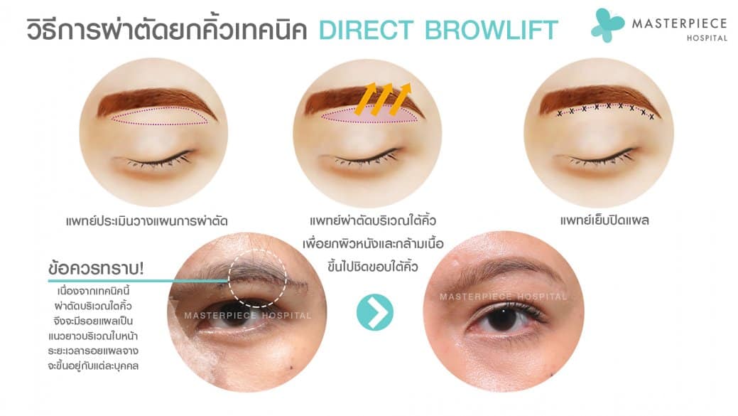 วิธีผ่าตัด-direct