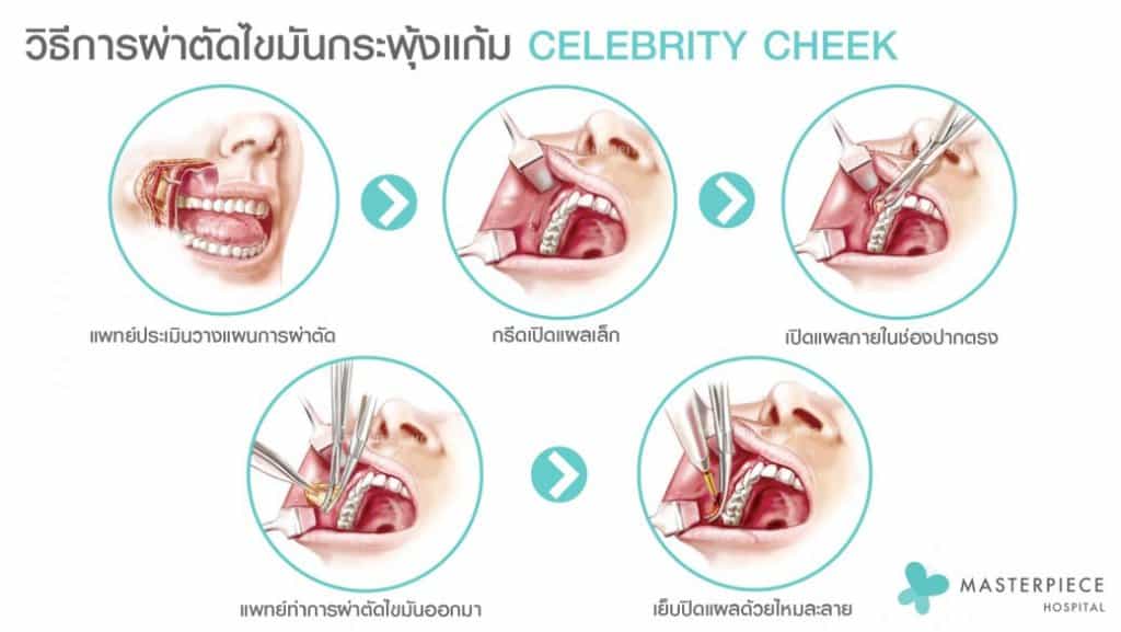 วิธีการผ่าตัดไขมันกระพุ้งแก้ม
