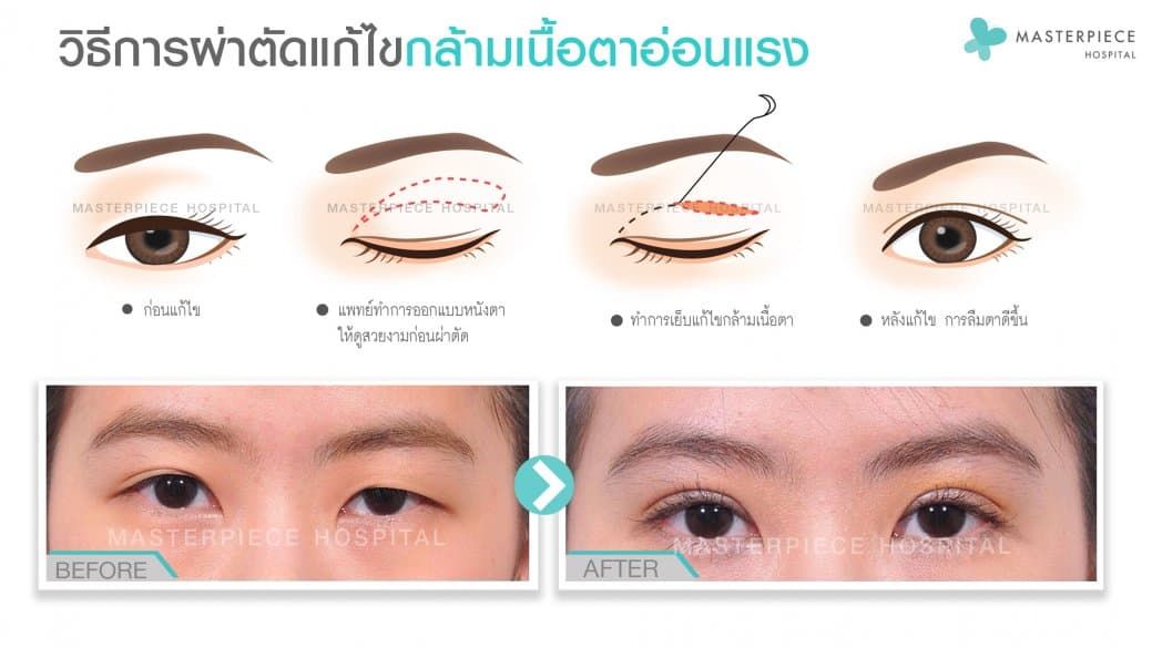 วิธีแก้ไขกล้ามเนื้อตาอ่อนแรง