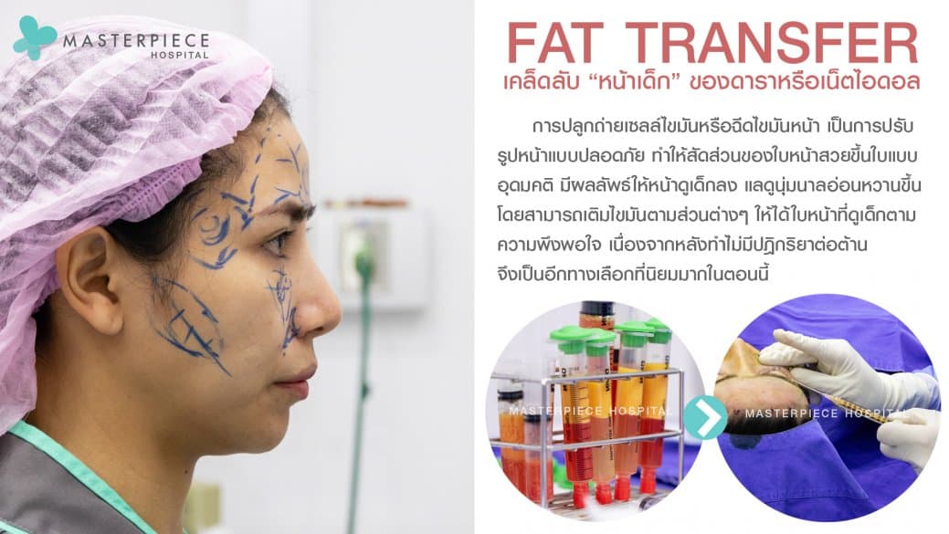 เคล็ดลับ ฉีดไขมันหน้า Fat Transfer