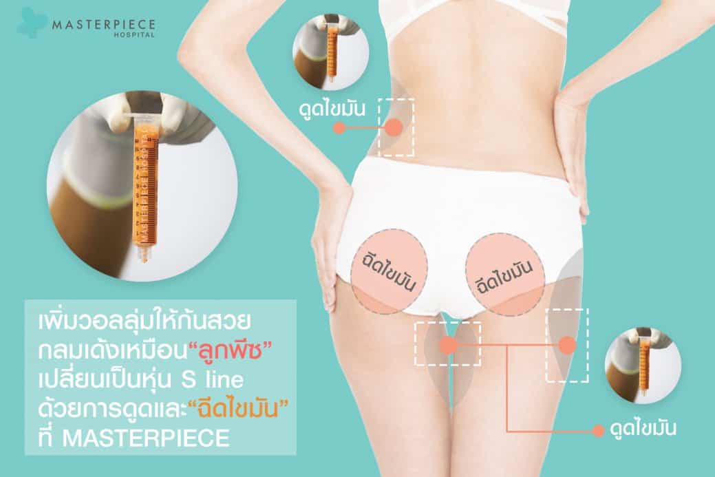 เติมไขมันก้น