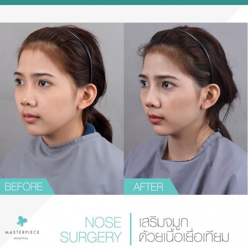 รีวิว เสริมจมูกด้วยเนื้อเยื่อเทียม