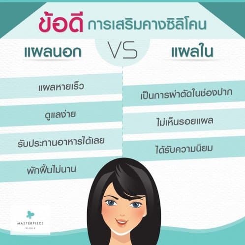 ข้อดีของการเสริมคางซิลิโคน