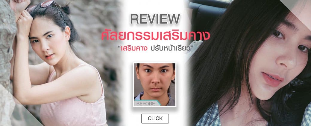 รีวิวเสริมคางซิลิโคน