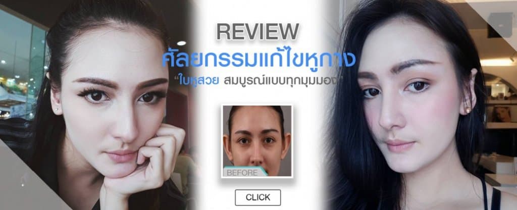 ศัลยกรรมแก้ไขหูกาง