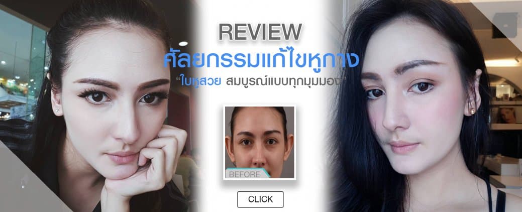 ศัลยกรรมแก้ไขหูกาง Otoplasty