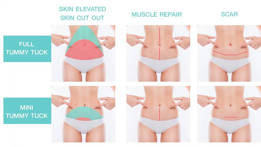 ผ่าตัด ตัดหนังหน้าท้อง Tummy Tuck