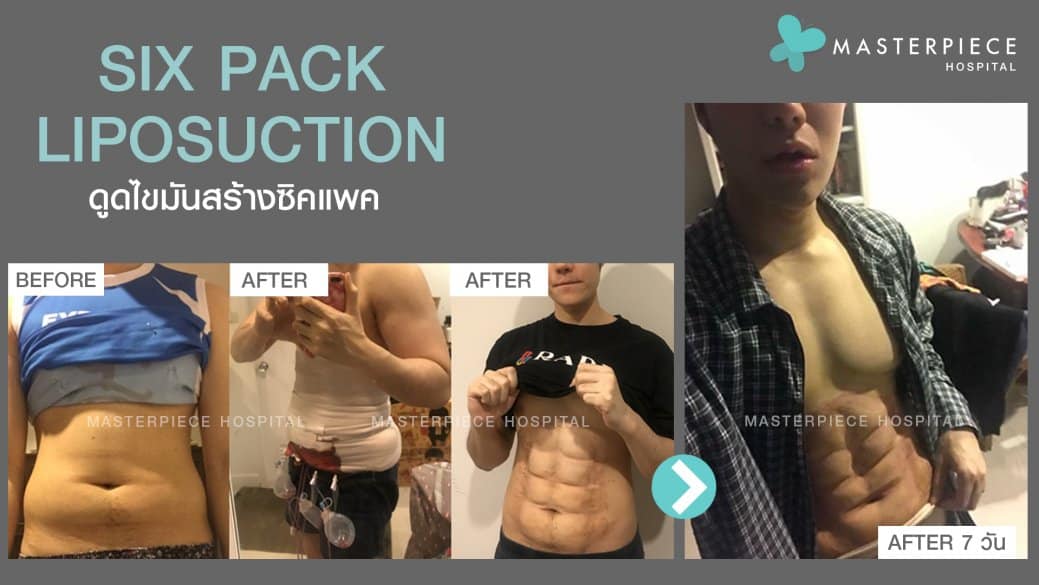 ดูดไขมัน ซิกแพค (SIX PACK LIPOSUCTION)