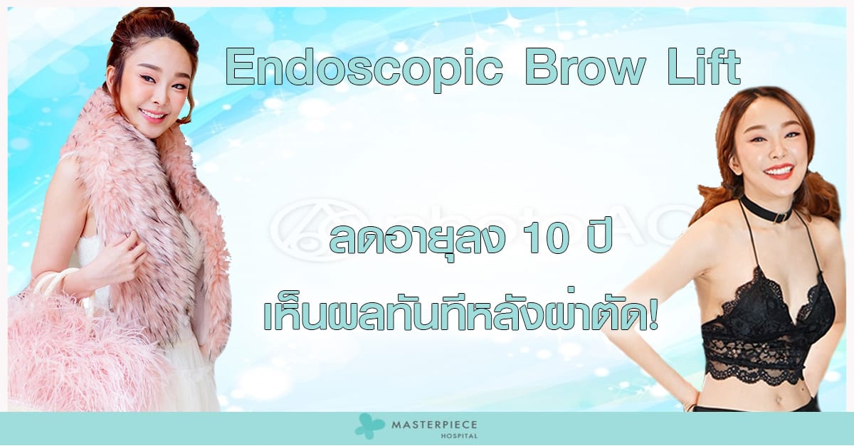 ยกคิ้ว Endoscopic Brow lift 