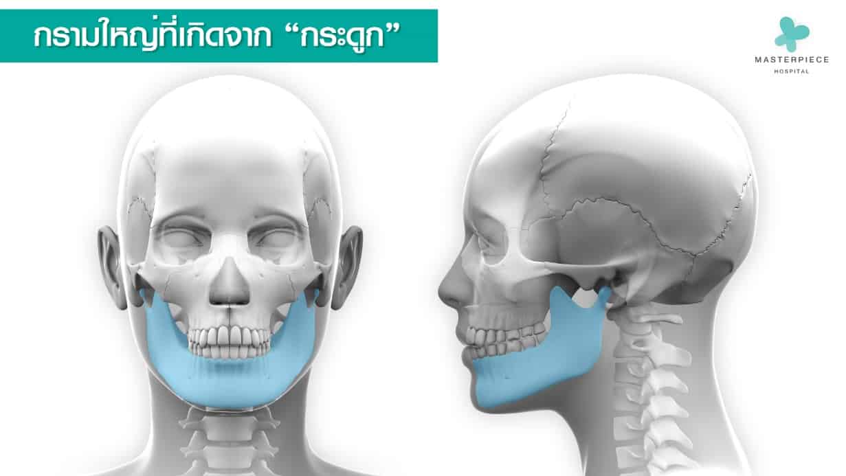 กรามใหญ่เกิดจาก กระดูก