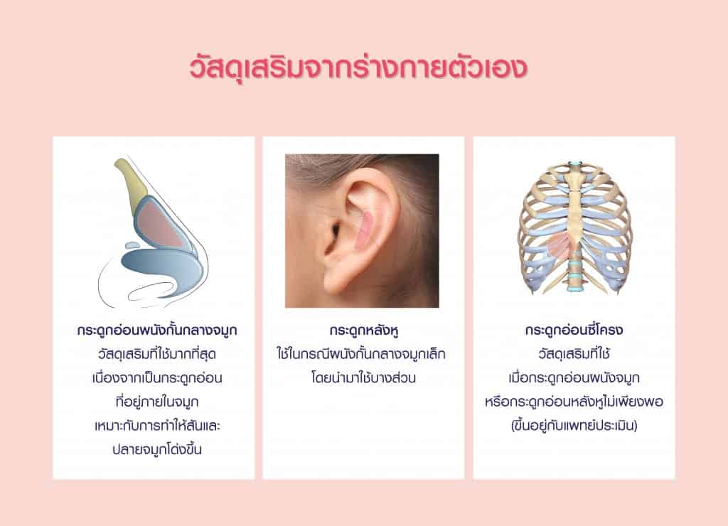 วัสดุที่ใช่เสริมจมูกโอเพ่น