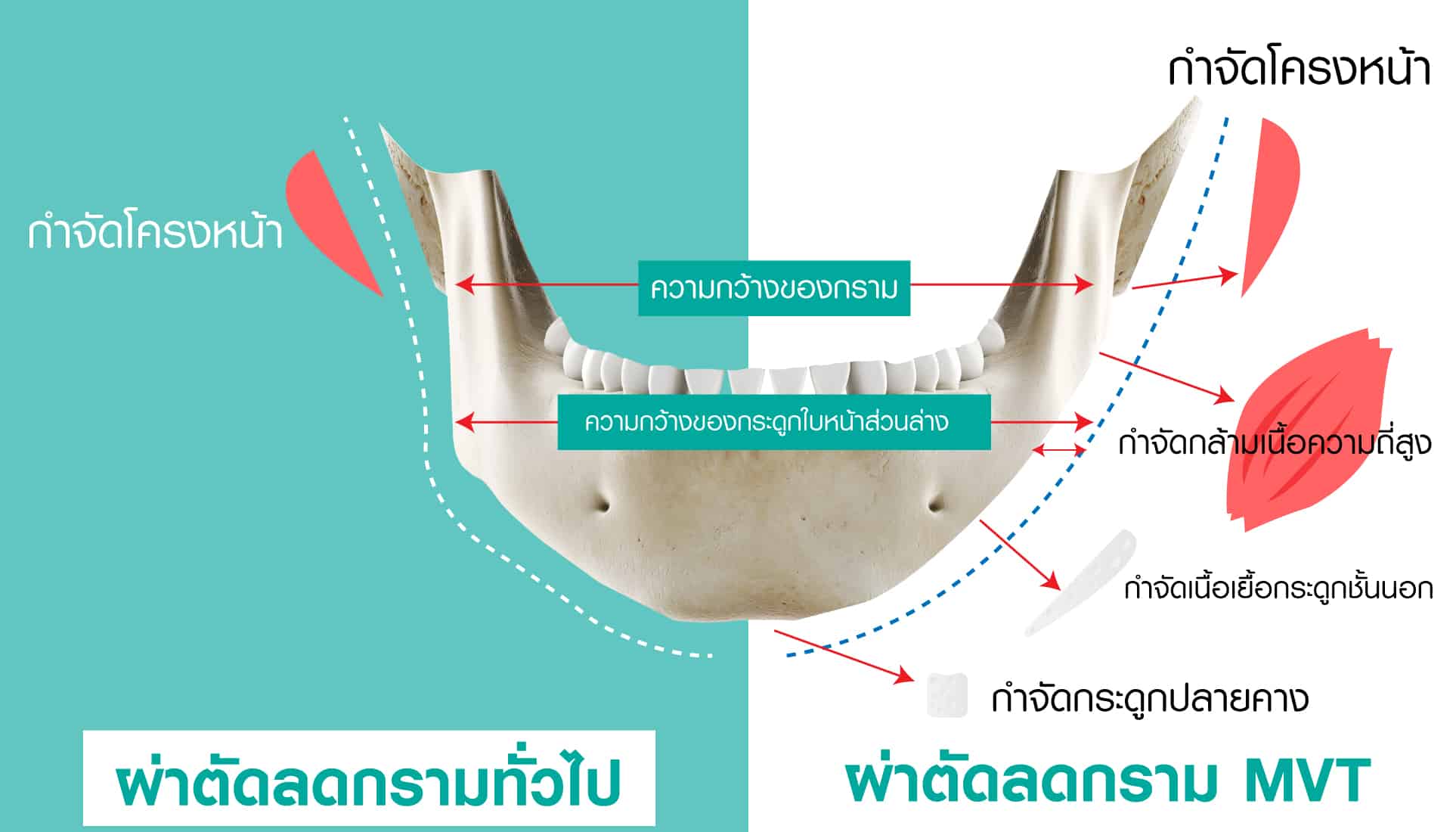 ตัดกรามแบบ MVT