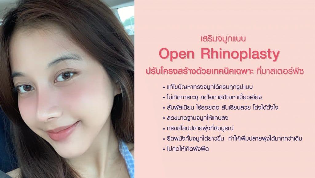 การแก้ไขโครงสร้างได้อย่างสมบูรณ์แบบ "ปลายไร้ซิลิโคน"
หรือที่รู้จักกันในชื่อเทคนิค " เสริมจมูกโอเพ่น " นั่นเอง