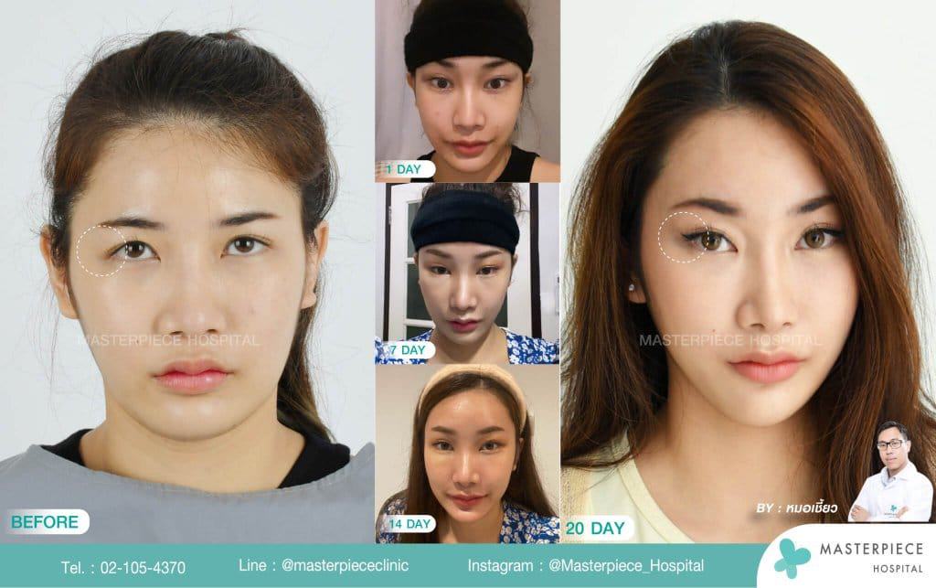 ภาพก่อนและหลังการทำศัลยกรรมฟ็อกซี่อาย