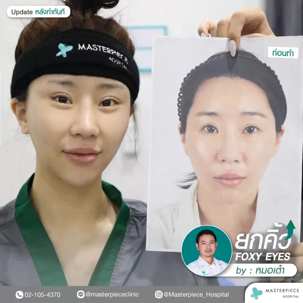 รีวิวก่อนและหลังการทำศัลยกรรมฟ็อกซี่อาย
