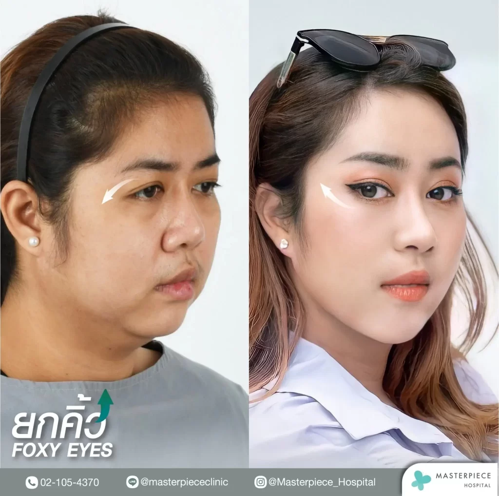 ภาพก่อนและหลังการทำศัลยกรรมฟ็อกซี่อาย