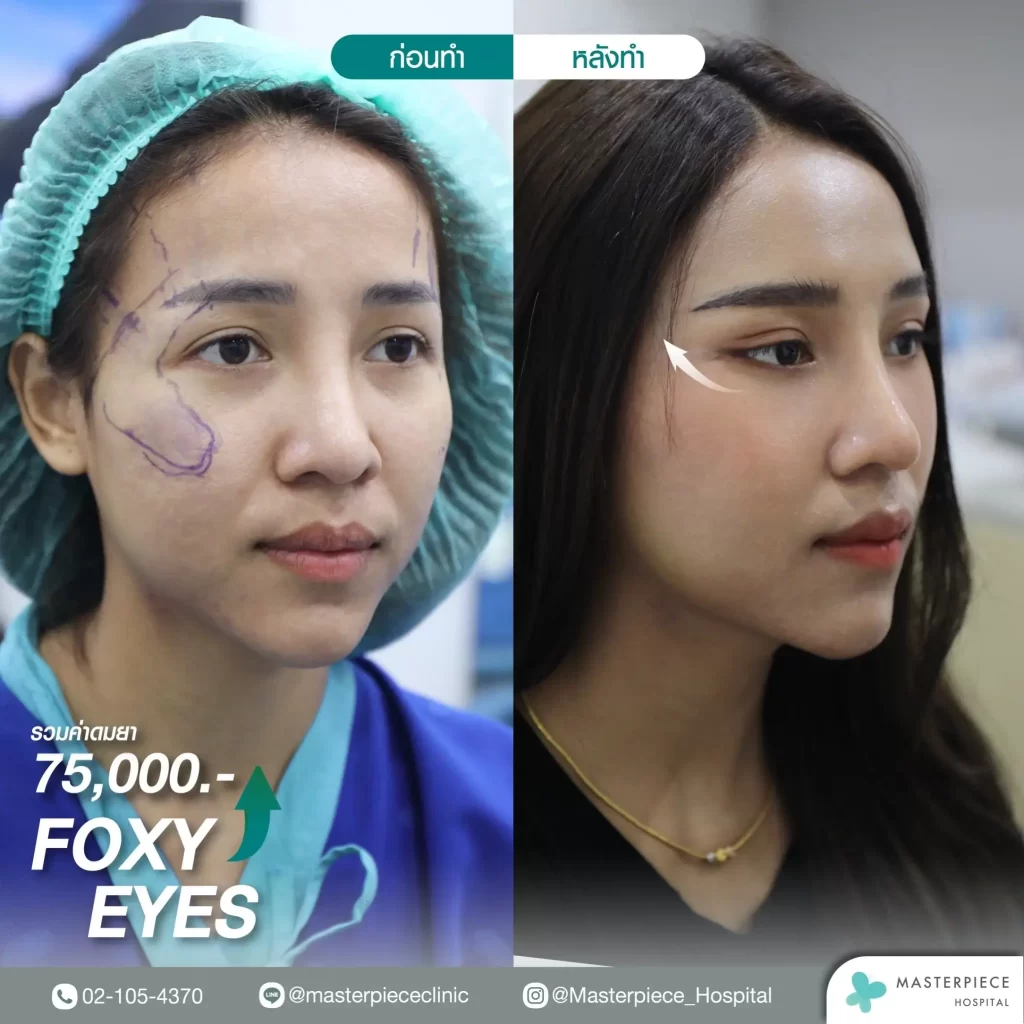 ภาพก่อน-หลังการทำฟ็อกซี่อาย