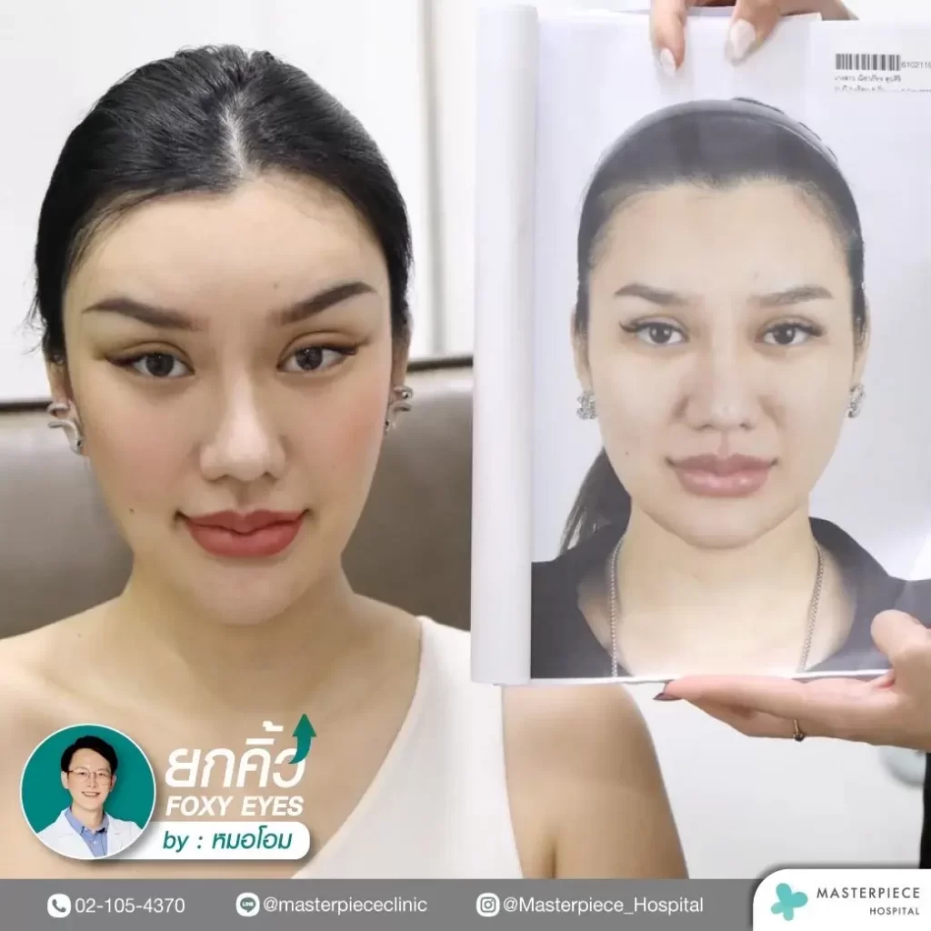 รีวิวก่อน-หลังการทำศัลยกรรมฟ็อกซี่อาย