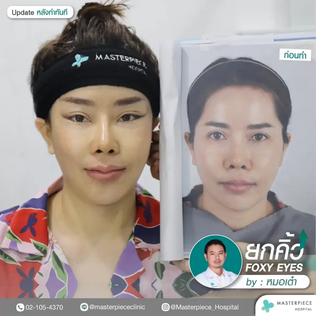 ภาพรีวิวก่อน-หลังการทำฟ็อกซี่อาย