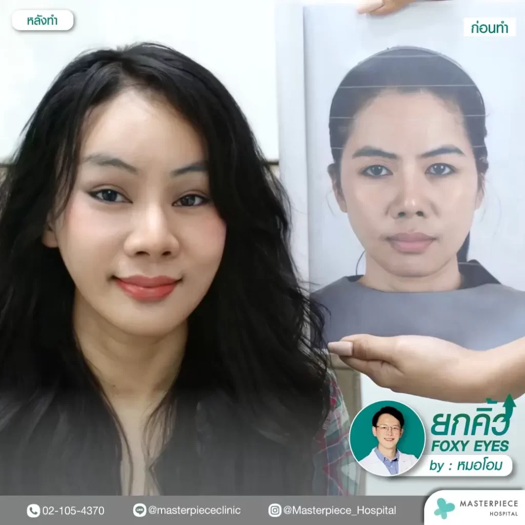 ภาพรีวิวก่อนและหลังการทำฟ็อกซี่อาย