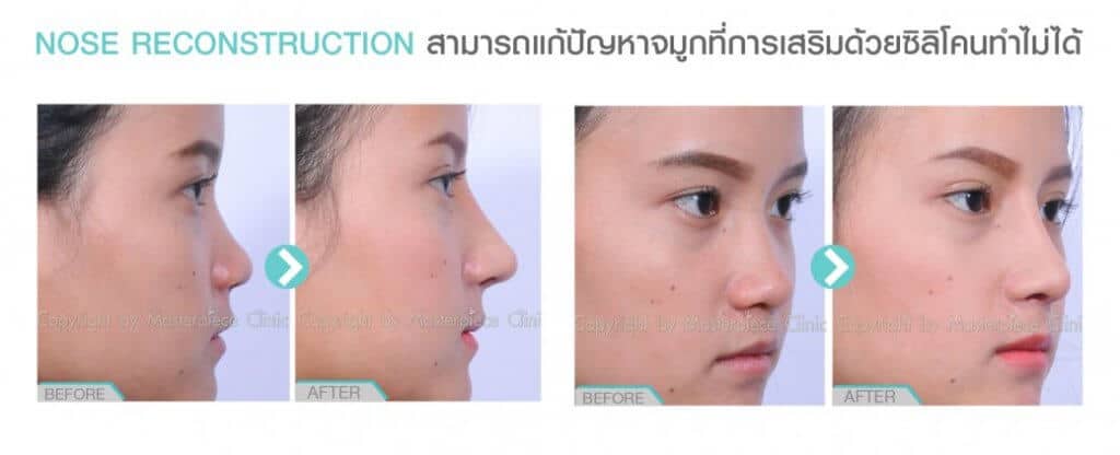รีวิวแก้จมูกแบบโอเพ่นโดยรวมทั้งหมดไม่เฉพาะแค่ความโด่ง ! จมูกโด่งเด่นอย่างเห็นได้ชัด