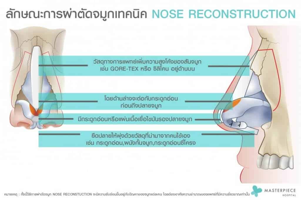 ลักษณะการผ่าตัด แก้จมูก