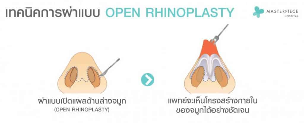 เทคนิคผ่าแบบ Open Rhinoplasty