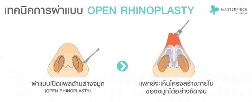เทคนิคการแก้จมูก open