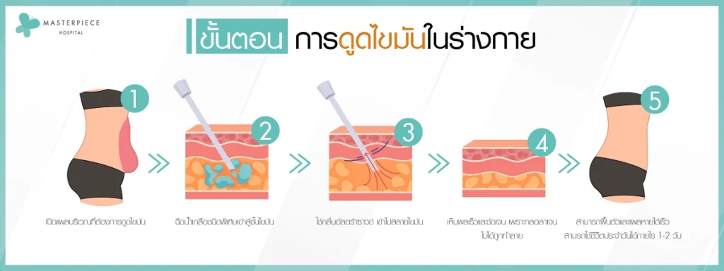 ขั้นตอนการดูดไขมัน 1200p
