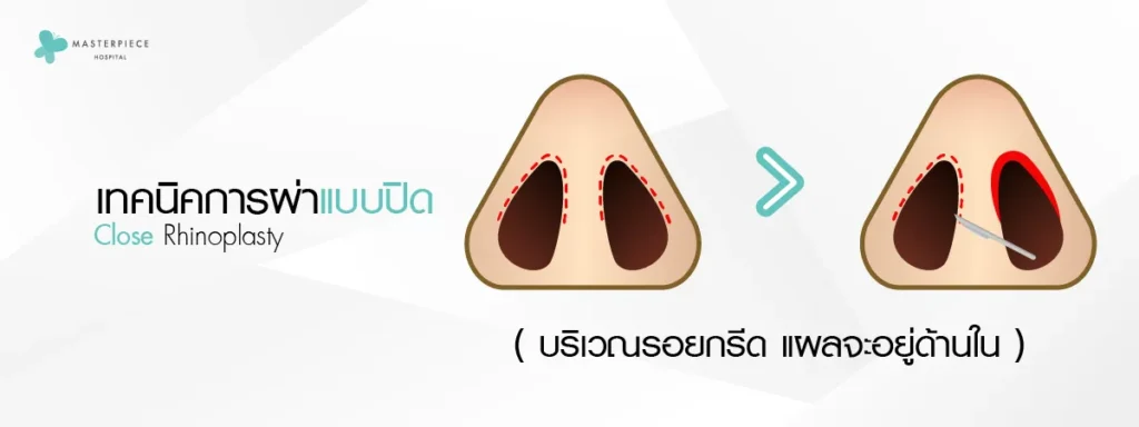 เทคนิคการผ่าแบบปิด