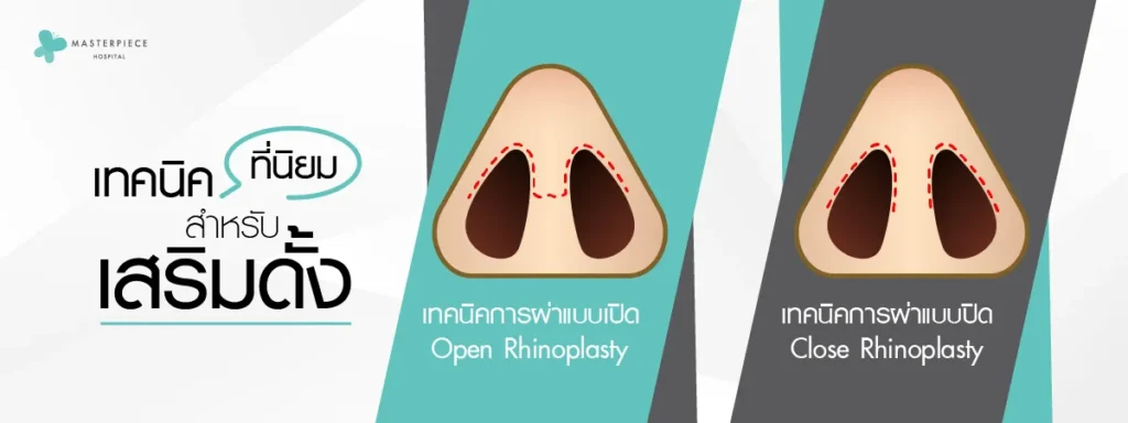 เทคนิคที่นิยมให้สำหรับเสริมดั้ง 