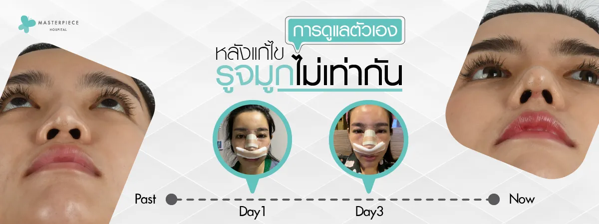 การดูแลตัวเองหลังแก้ไขรูจมูกไม่เท่ากัน