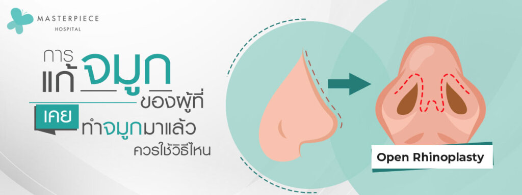 การแก้จมูกของผู้ที่เคยทำจมูกมาแล้วควรใช้วิธีไหน