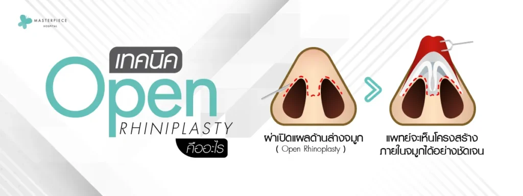 เทคนิค open คืออะไร 30-03-2023