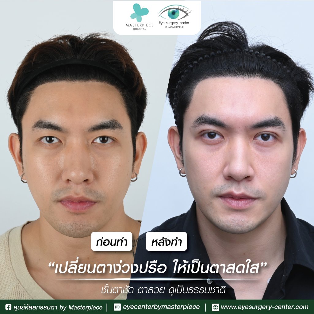 รีวิว ตาสองชั้น ผ่าตัดถุงใต้ตา