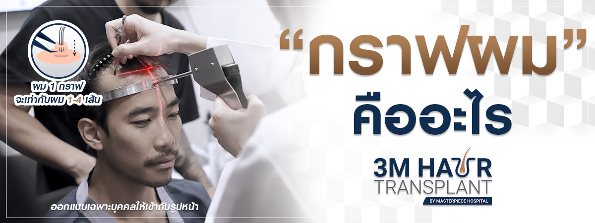 ปลูกผม กราฟผมคืออะไร