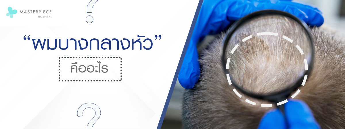 ผมบางกลางหัว คืออะไร